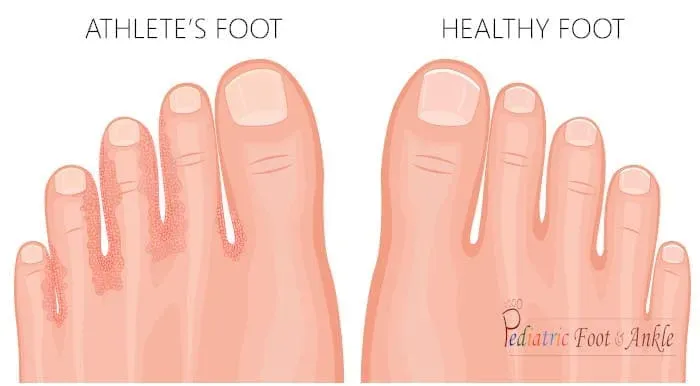 Foot care treatment