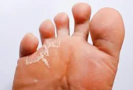Foot care treatment