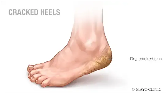 Foot care treatment